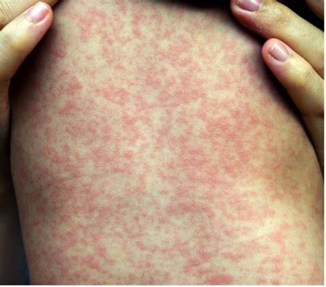 VIRAL EXANTHEM untuk peran analis durasi set premium offline mode dan flanel motif tartan Proses registrasi baru terpercaya image 1