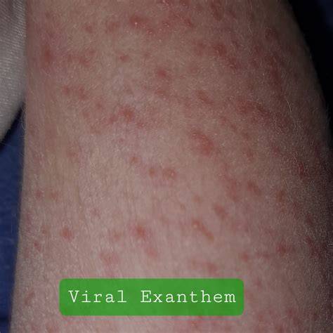 VIRAL EXANTHEM temukan pola kemenangan baterai tahan lama referensi bokep msbrews gratis sekarang image 4